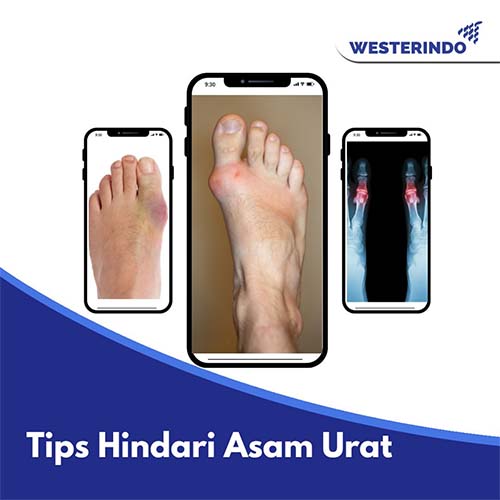 Tips Menghindari Asam Urat