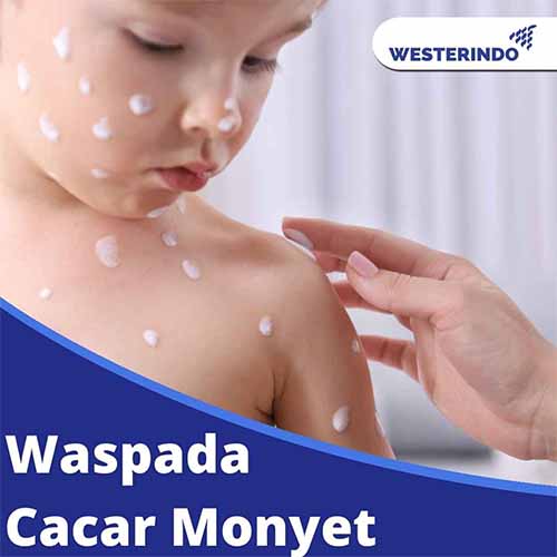 Apa itu Cacar Monyet dan Cara Pencegahannya