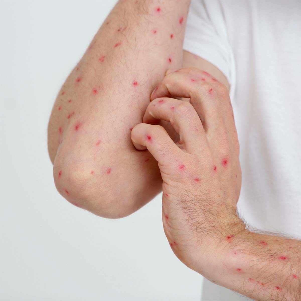 Memahami Monkeypox: Gejala, Penyebab, Pencegahan, dan Pengobatan
