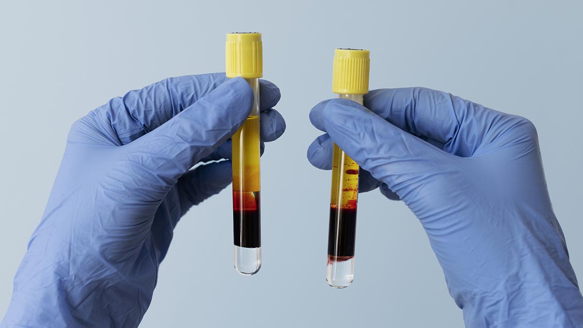 Platelet Rich Plasma / PRP: Seperti Ini Prosedur Lengkapnya