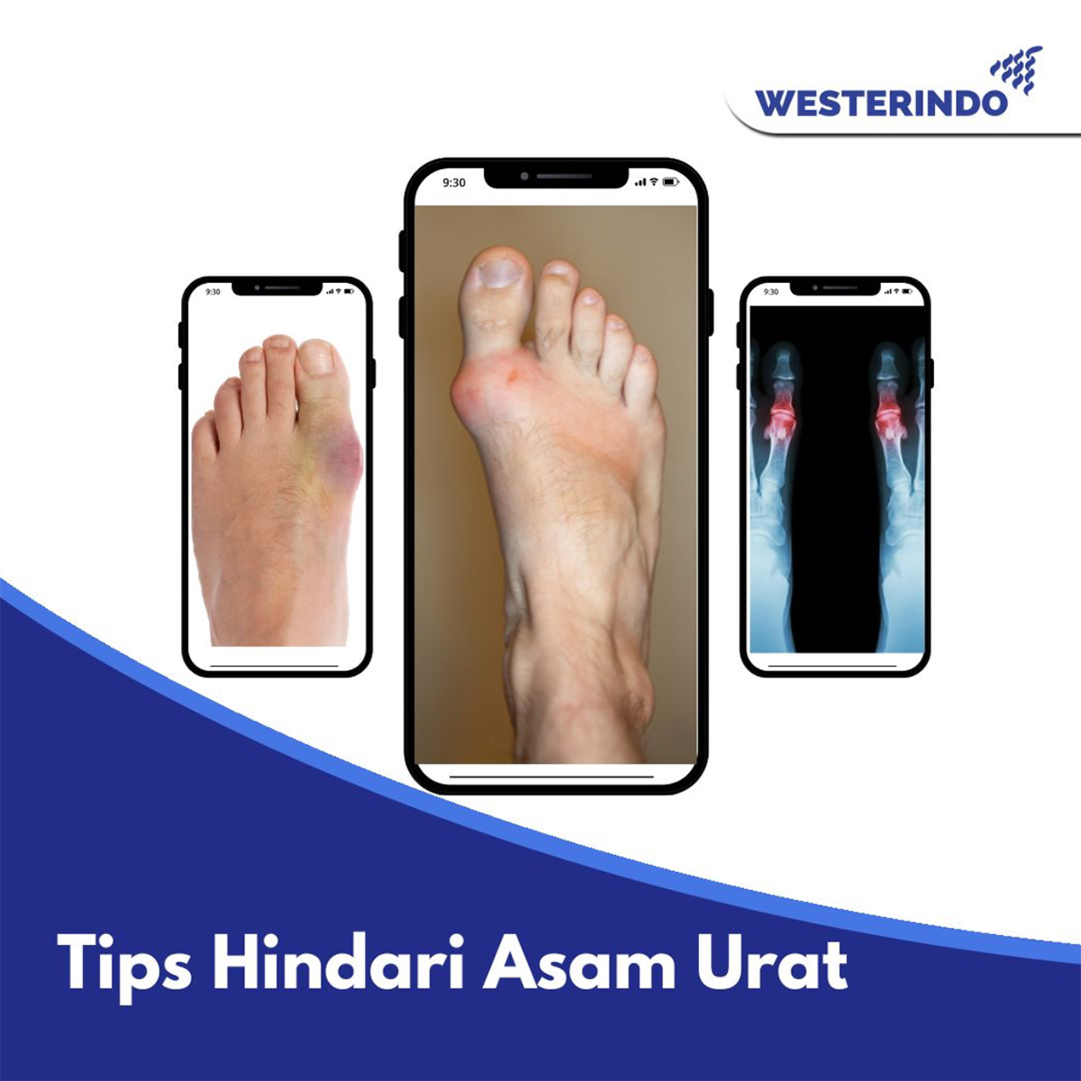 Tips Menghindari Asam Urat