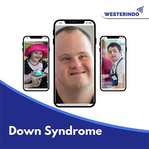 Down Syndrome